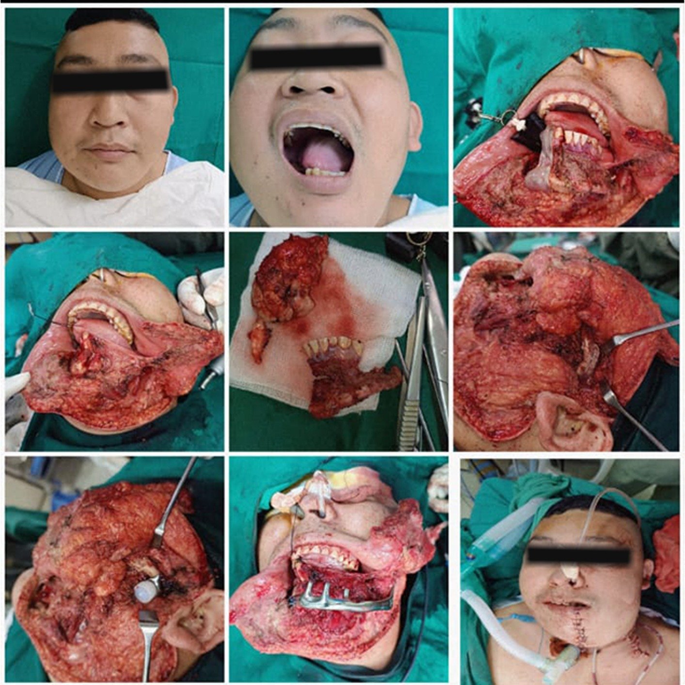 total TMJ replacement